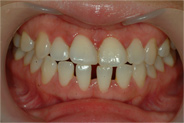 치아가 듬성듬성